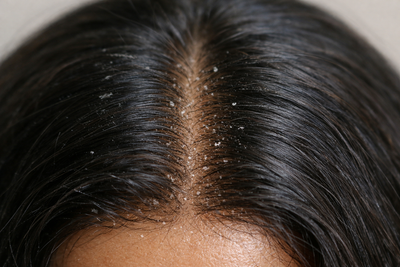 I have oily, flaky dandruff