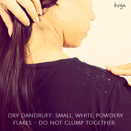 Persistent dandruff: dry dandruff flakes are small, white and powdery