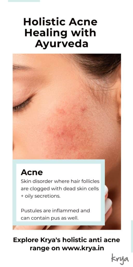 ayurvedic acne treatment plan - what is acne