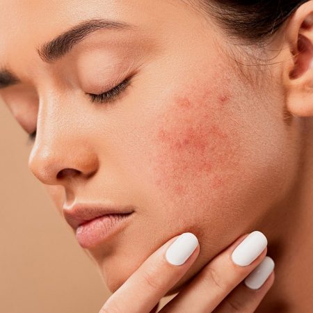 ayurvedic acne treatment - blog post by krya